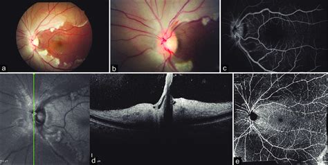 A Left Eye Retinography Showing Retinal Pallor Sparing The Macular