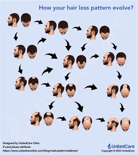 Male Pattern Baldness Identification Causes Treatment And Patterns