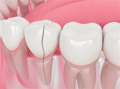 Ways To Fix A Cracked Tooth Austin Laser Dentist Helen Ragsdale