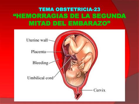 Ppt Tema Obstetricia Hemorragias De La Segunda Mitad Del Embarazo