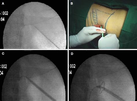 Nephrostomy Tube Ultrasound