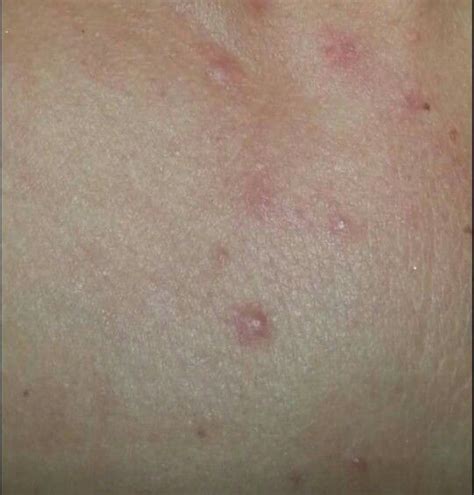 Photosensitivity Lupus Rash From Sun Exposure Lupus Rash Rash From Sun Fibromyalgia