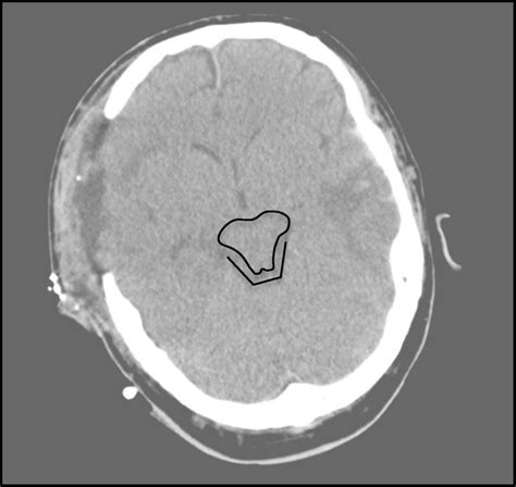 Ct Scan At Level Of Quadrigeminal Cistern Demonstrating The Three