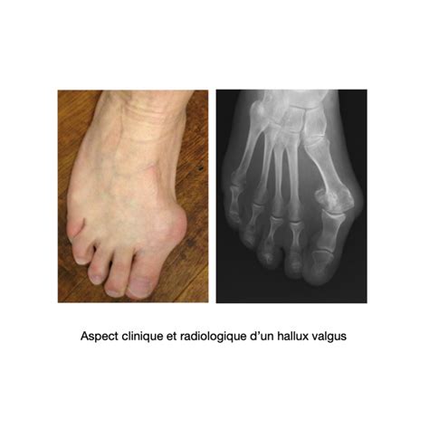 Hallux Valgus Sévère Dr Bovier Lapierre