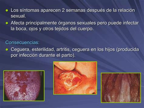 Enfermedades Venereas Ppt