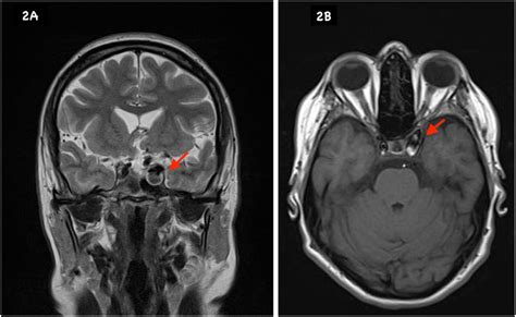 Sellar Mri Sagittal A T Pre Contrast Shows An Isointense