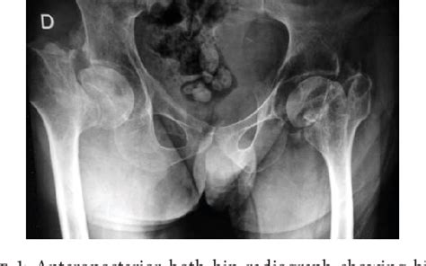 Figure From Bilateral Simultaneous Femoral Neck Fracture Mimicking