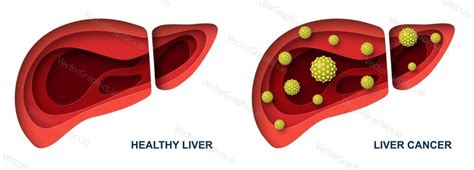 Liver Cancer And Healthy Organ Vector Illustration — Vectorgraphicsio