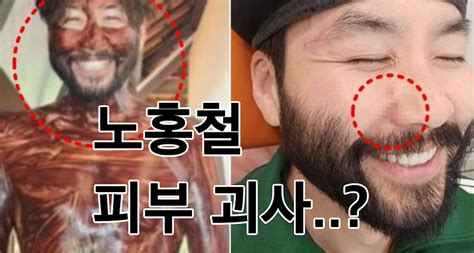 노홍철 피부 괴사 베트남 오토바이 사고 후 얼굴 상태 근황 한국 재수술 이라키 위키