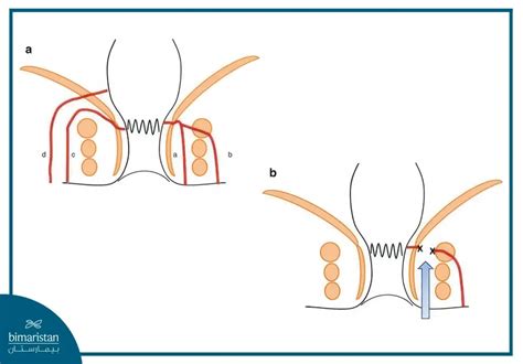 Anal Fistula Treatment Best Options For Fast Recovery