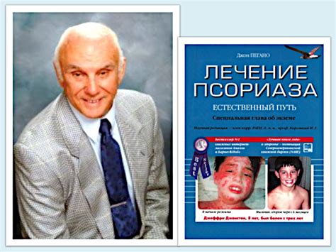 Пегано – лечение псориаза «Естественный путь»: 6 шагов к выздоровлению ...