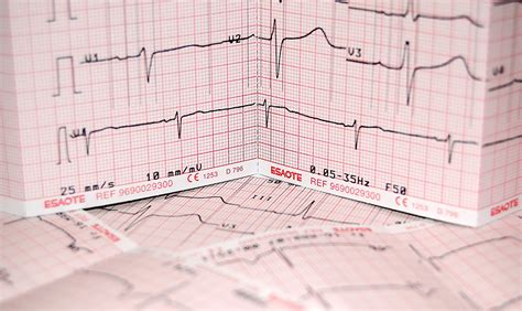 Ekg Rhythm Strips