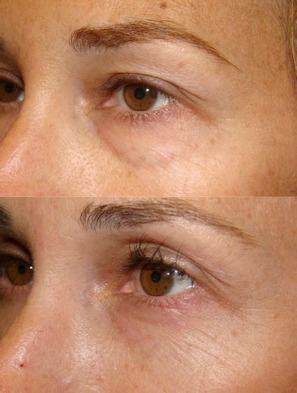 Upper Blepharoplasty Dr Guy Massry