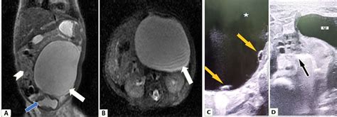 Daughter Cyst Sign In The Congenital Ovarian Cyst Bmj Case Reports