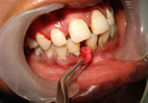 Oral Pyogenic Granuloma Tongue