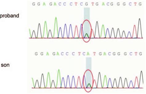 Sanger Dna Sequencing Profiles The Proband Carry A Novel Mutation