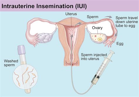 IUI Vs IVF Similarities And Differences