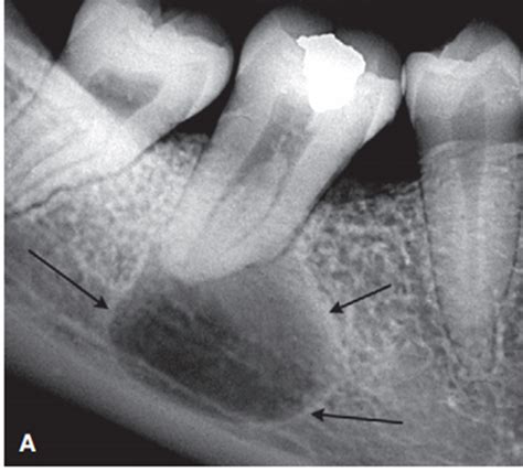 Kista Radikular Radicular Cyst