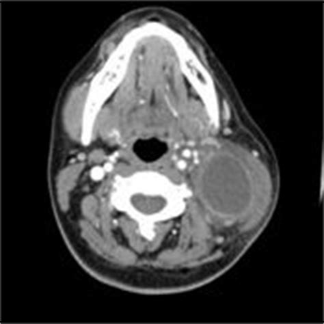 Tonsil Cancer Symptoms