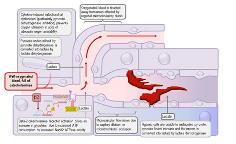 Lactic Acidosis In Sepsis And Septic Shock Deranged Physiology