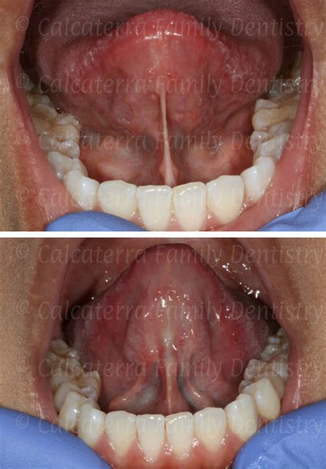 Labial Frenectomy Before And After