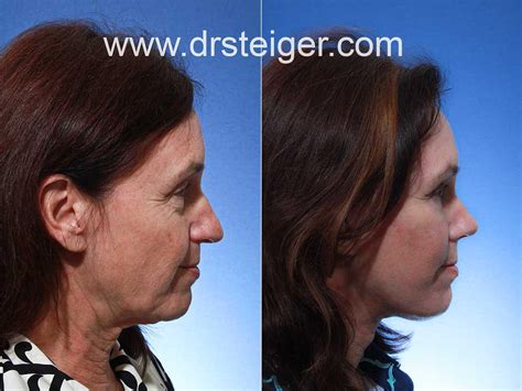 Facelift With Rhinoplasty Steiger Facial Plastic Surgery Boca Raton