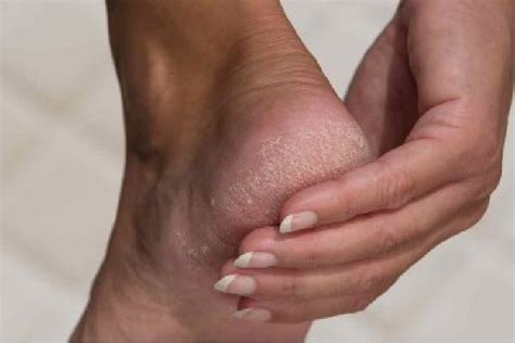 Winter Foot Care How To Care For Your Soles During Harsh Winters Dgtl