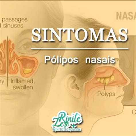 Pólipos nasais muito pequenos podem não causar sintomas Pólipos