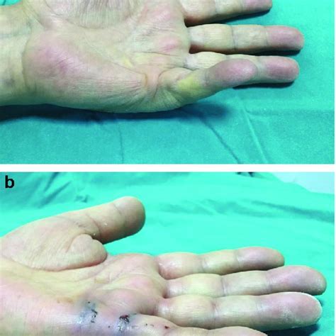 Preoperative Photo Of Patient With Stage 1 Dupuytrens Contracture A