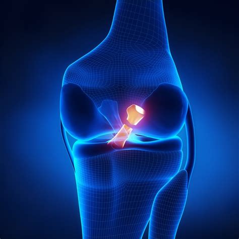 Frontal Plane Knee Motion and ACL Tears by Chris Graham - Athletic Lab