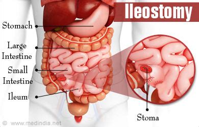 Ileostomy - Types, Tests Required, Benefits and Risks