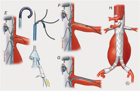 Techniques Of Implantation Of Fenestrated And Multibranched Stent Grafts For Visceral Artery