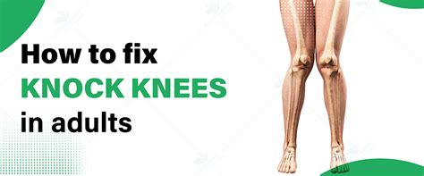 How To Fix Knock Knees In Adulthood Exercises And Treatments