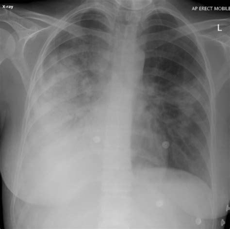 Respiration Exam 3 Flashcards Quizlet