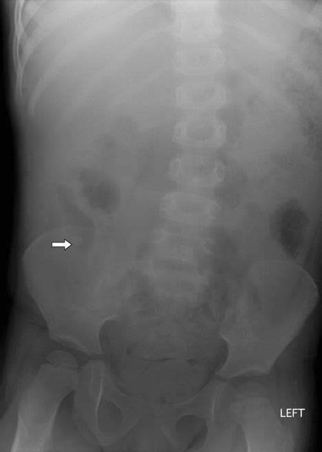 Appendicitis Radiology Key