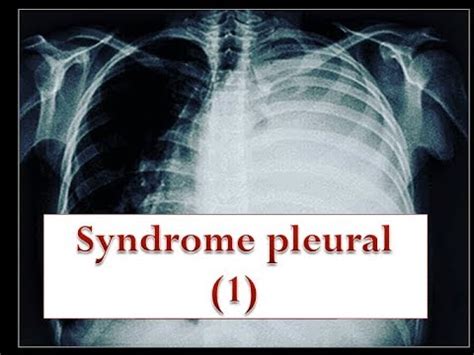 Le Syndrome Pleural Partie 1 YouTube