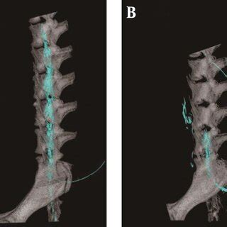 a - Full-thickness burn eschar, the result of a road accident, during ...