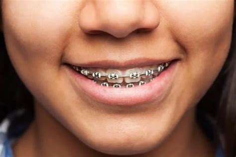 Edad Ideal Para Ponerse Brackets 1 100 Doctora Gina Ardila