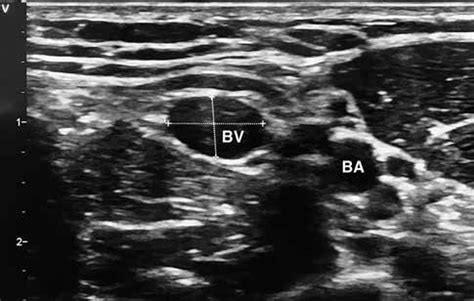 Pre-procedure ultrasound examination showing vascular structures. BV ...