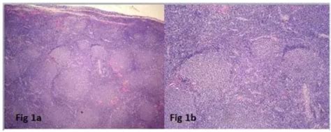 What is Follicular Lymphoma? - Pathosomes