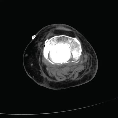 Ct Scan A Axial B 3 D Reconstruction At Six Months Download Scientific Diagram