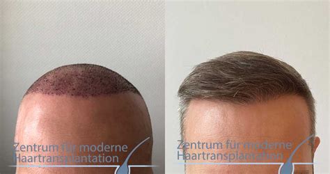 Glatzenbildung Helfen Therapien Haartransplantation Bei Einer Glatze