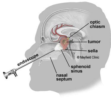 functional endoscopic sinus surgery - Felicity Hill