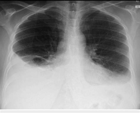 Chest Xray Posteroanterior View Showing Rightsided Pleural Effusion Images