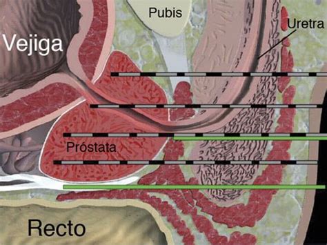 Prostate Cancer Centro Gil Vernet De Urolog A