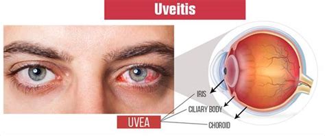 Uveitis Penanganan Dan Pengobatan