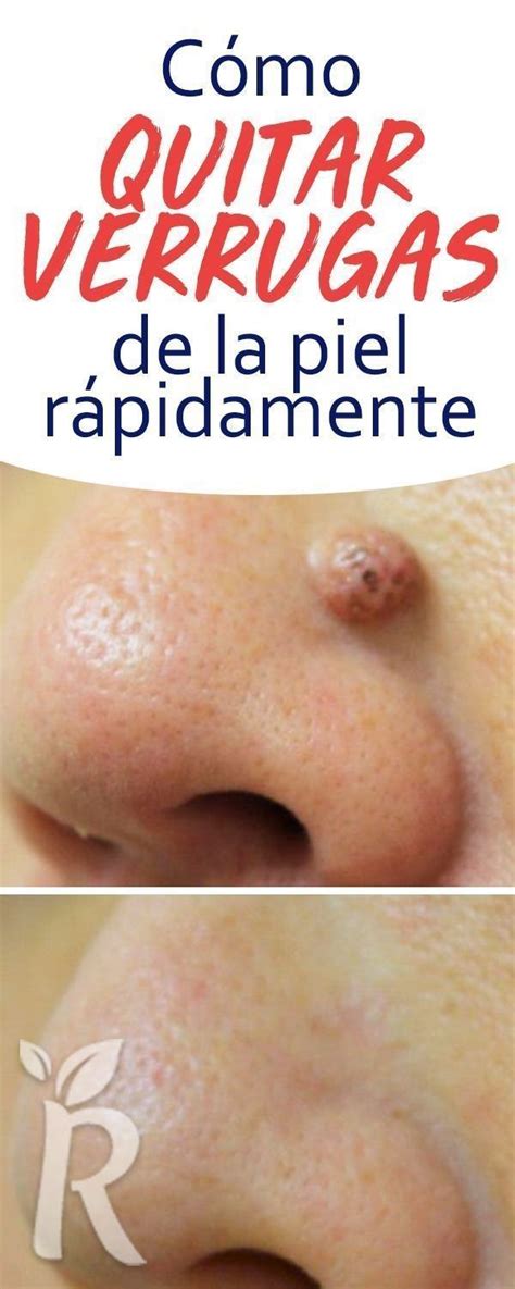 Remedios Naturales Para Eliminar Las Verrugas De Tu Cuerpo Como