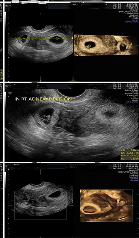 Ultrasonographic aspects of heterotopic pregnancy | Download Scientific ...