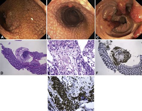 Unusual Yellow Scaly Colonic Mucosal Appearance Tangier Disease Gastrointestinal Endoscopy