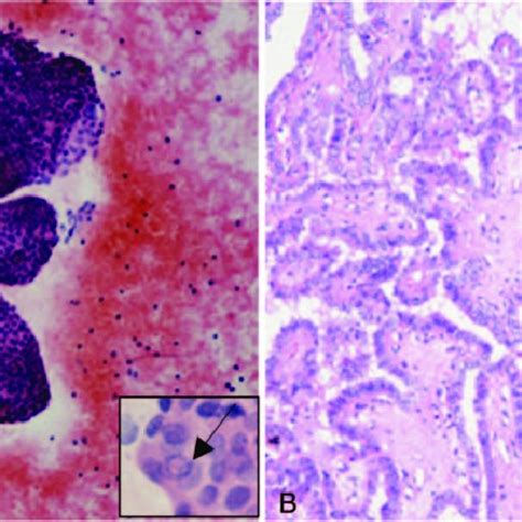 Fna And Histological Slides Of Papillary Thyroid Cancer A